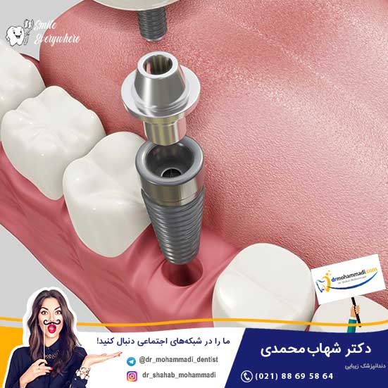 ایمپلنت ایرانی؟ آیا ایمپلنت در ایران تولید می شود؟ - کلینیک دندانپزشکی دکتر شهاب محمدی